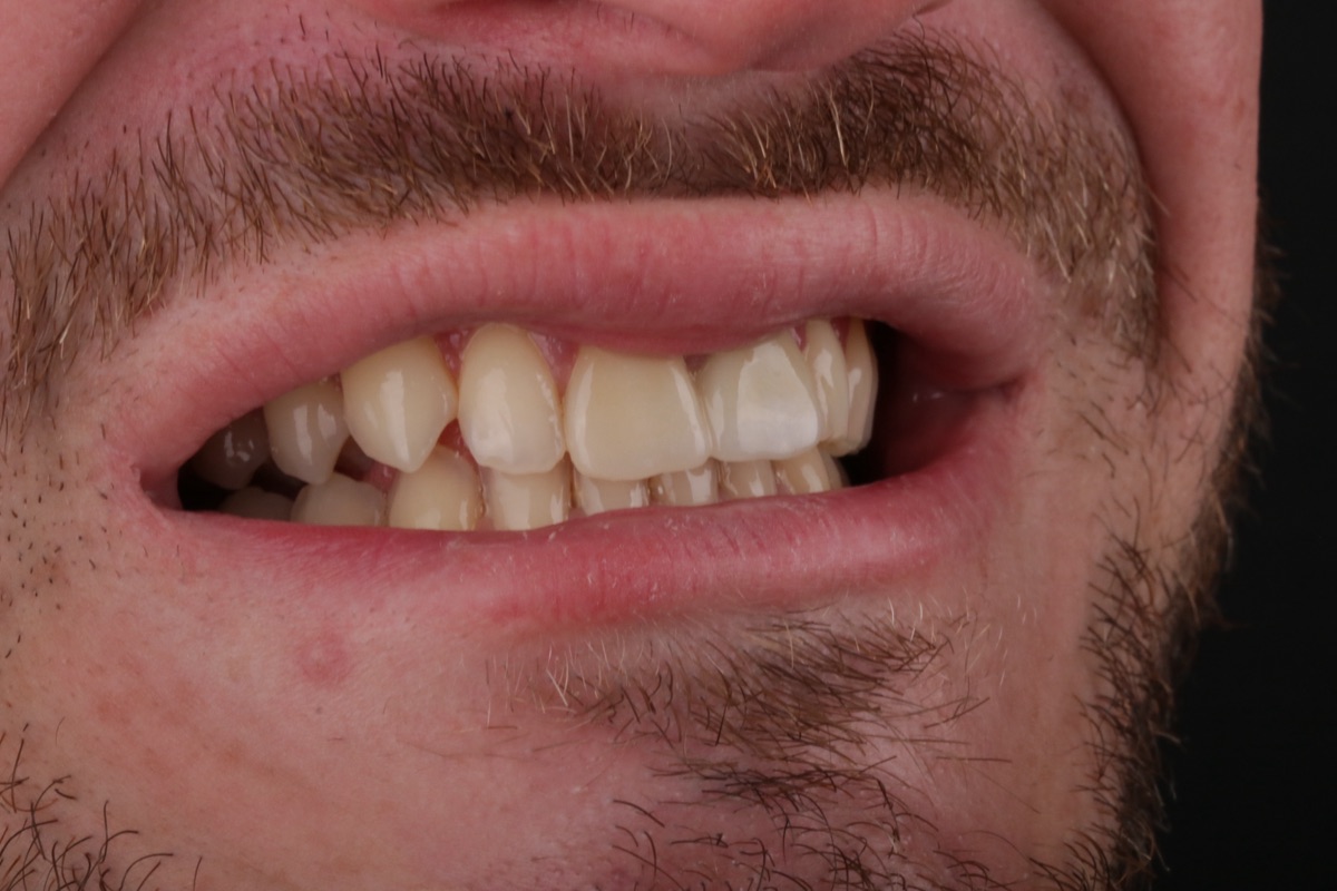 Before veneers - Alexis