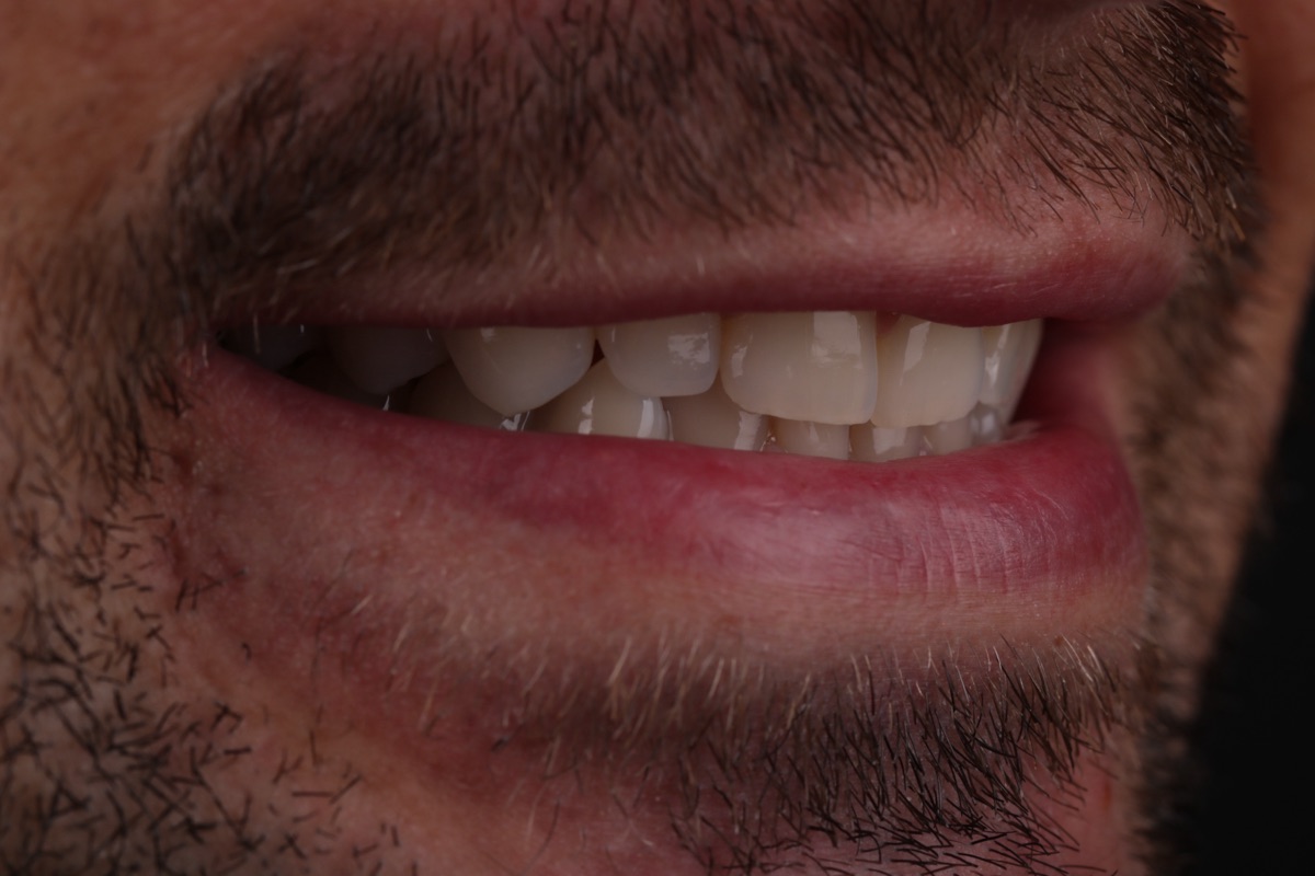 Before veneers - Antony