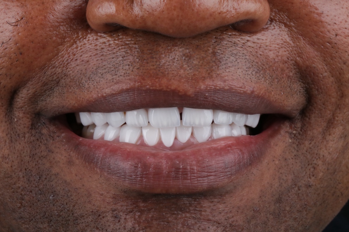 After no-prep veneers - Armel