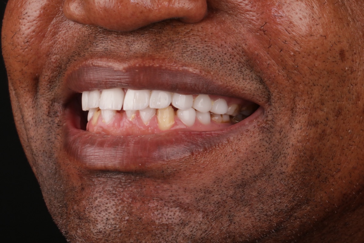 Before veneers - Armel