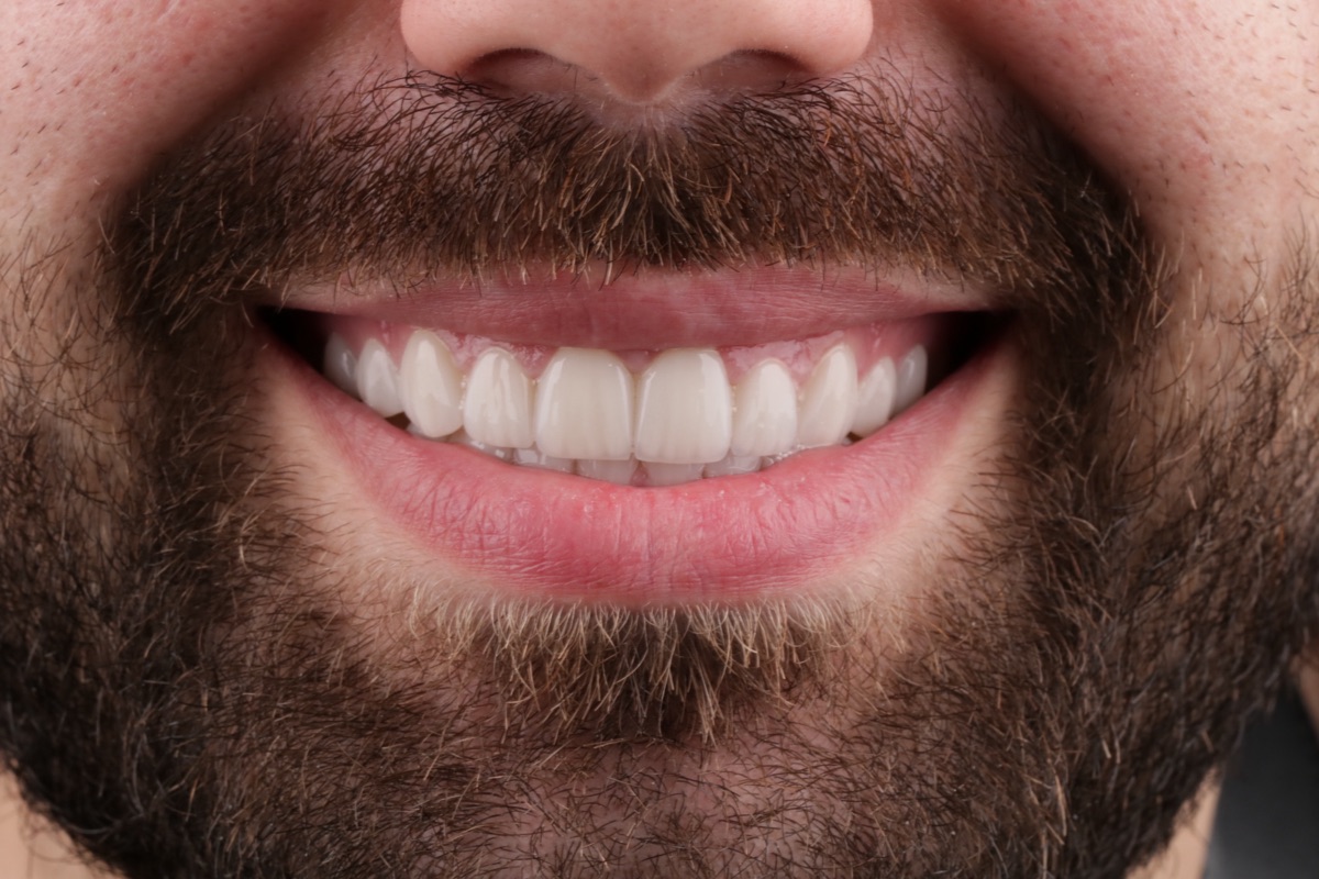 After Hollywood Smile veneers