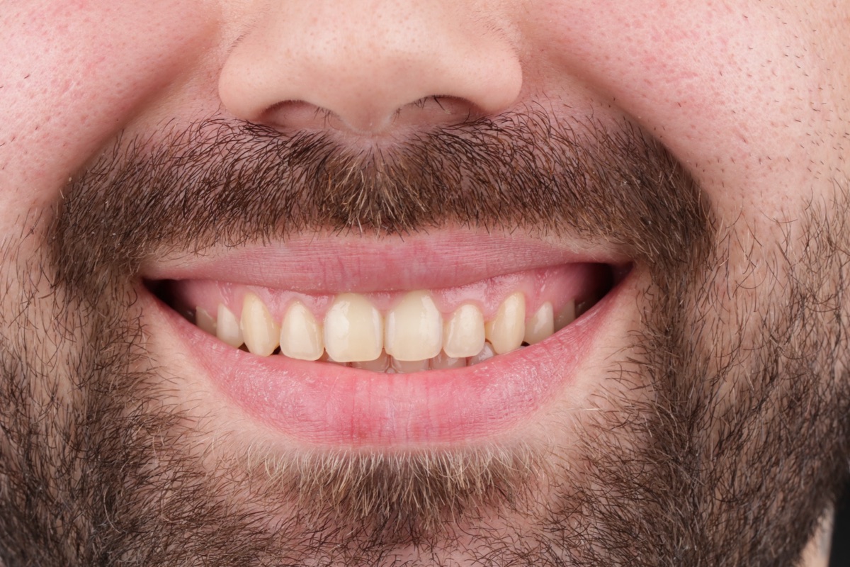 Before Hollywood Smile
