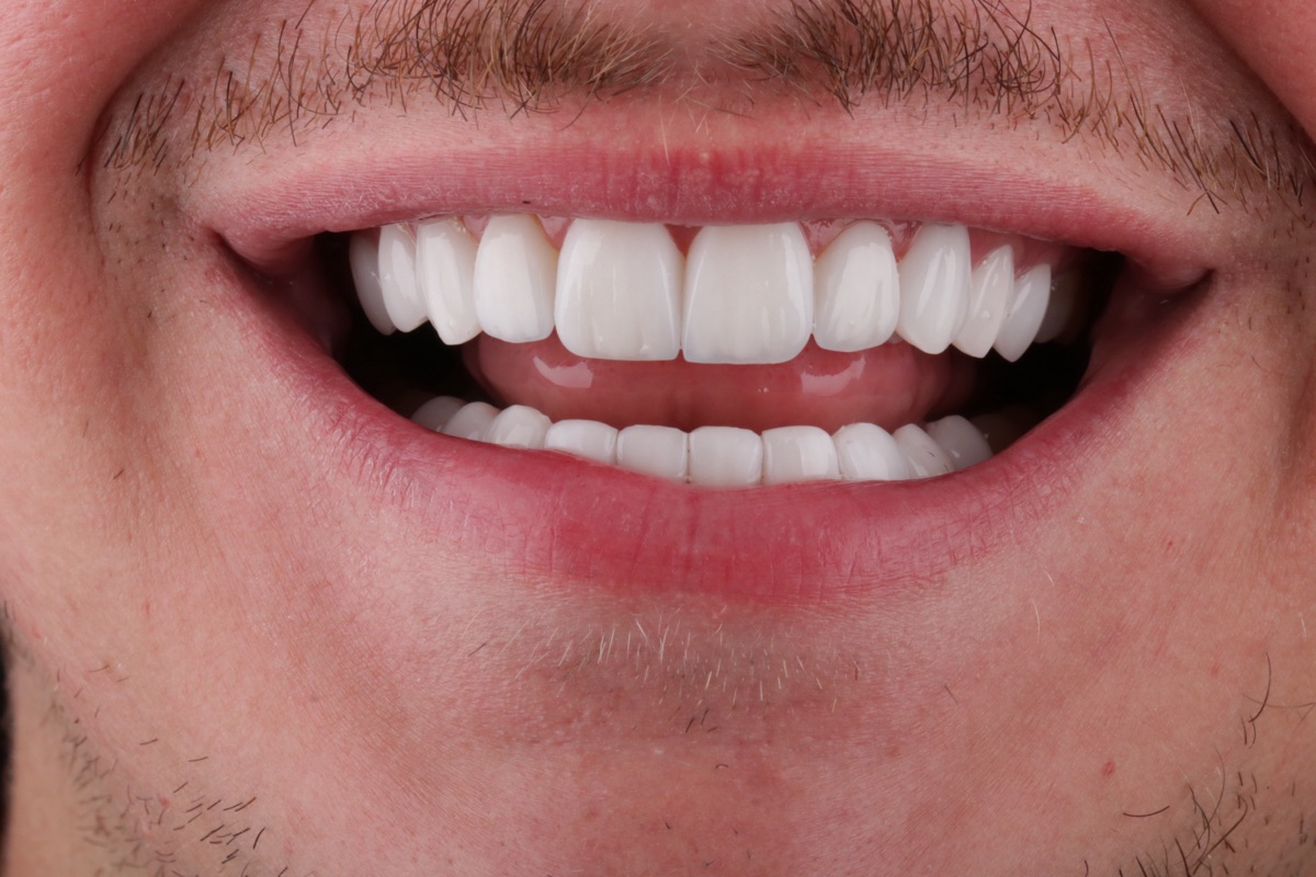 After no-prep veneers - Florian