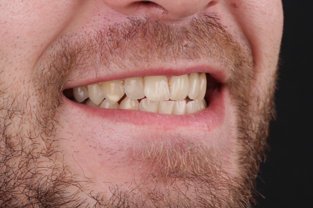 Before veneers - Franciase
