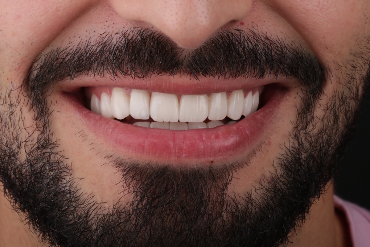After no-prep veneers - Jamal