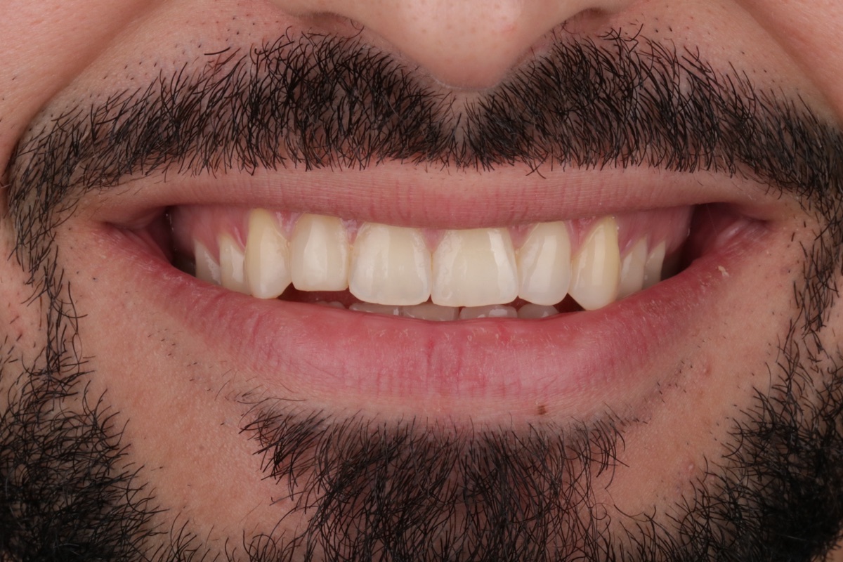 Before veneers - Jamal