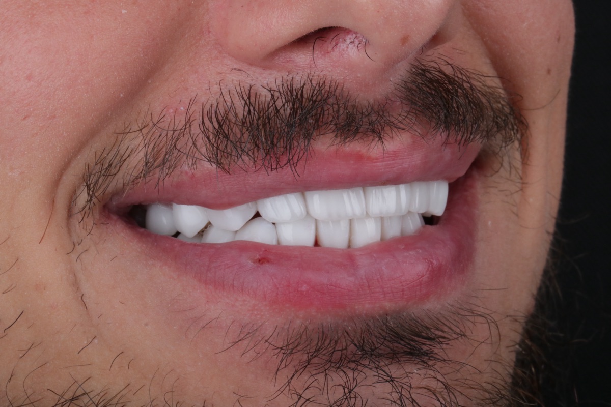 After no-prep veneers - Jommet