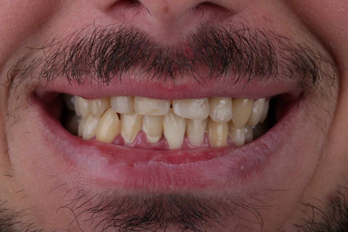 Before veneers - Jommet