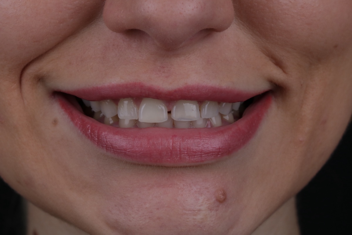 Before veneers - Lea