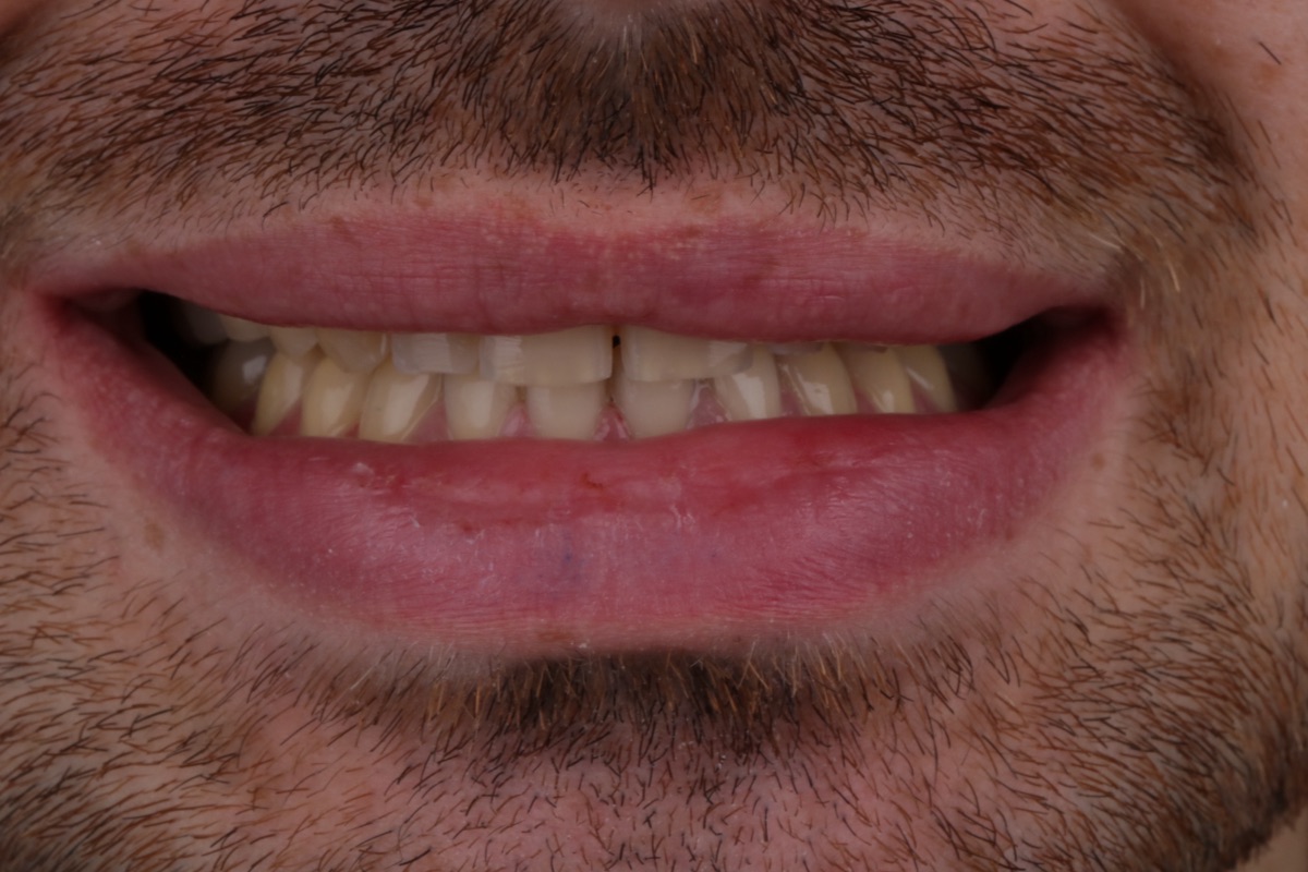 Before veneers - Loup