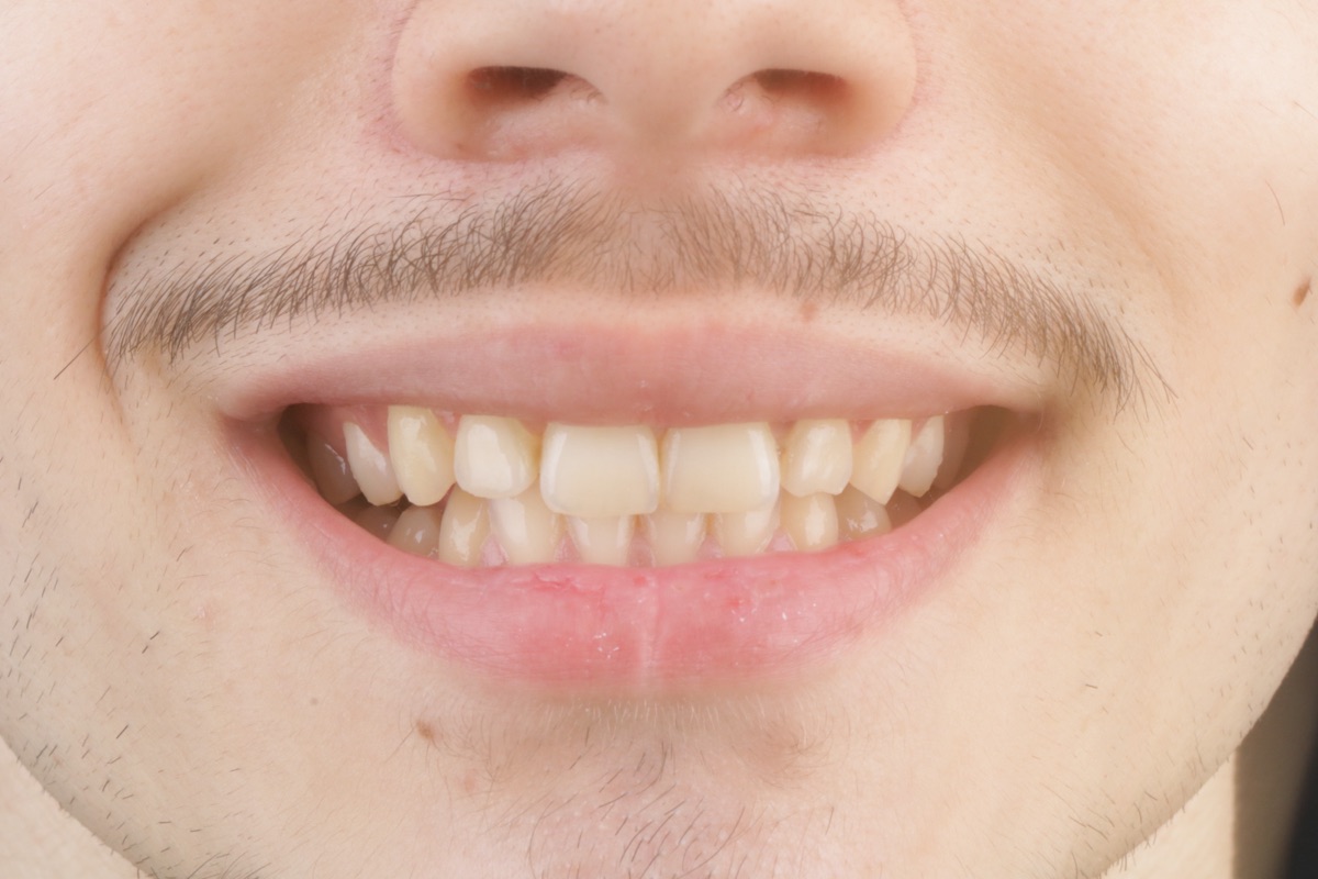 Before veneers - Nhat Leo