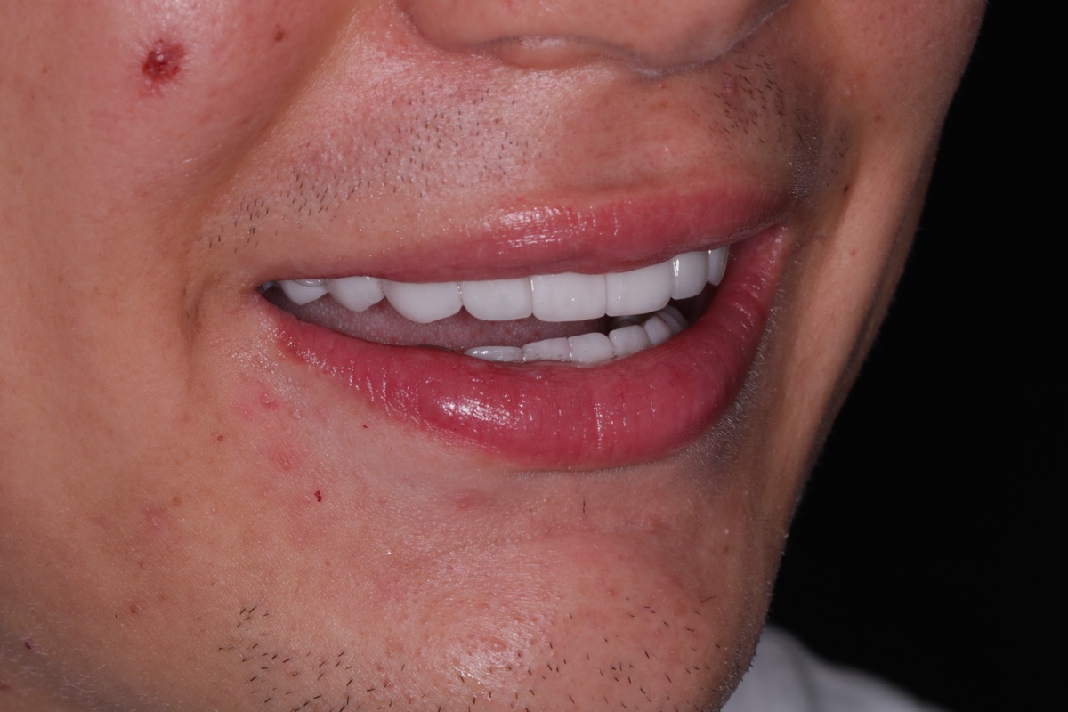 After no-prep veneers - Noah