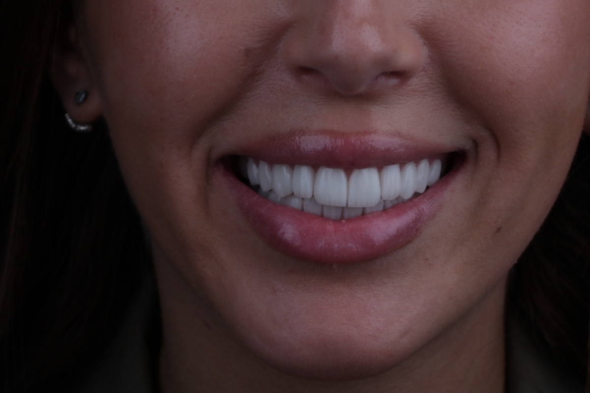After no-prep veneers - Sephora